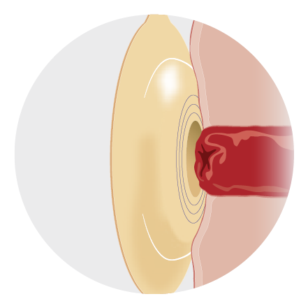 Convex barrier pressure