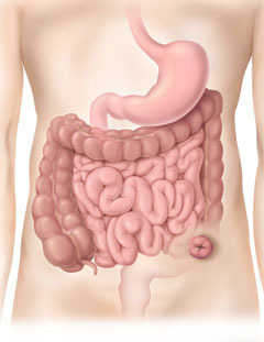 Sigmoid Colostomy 