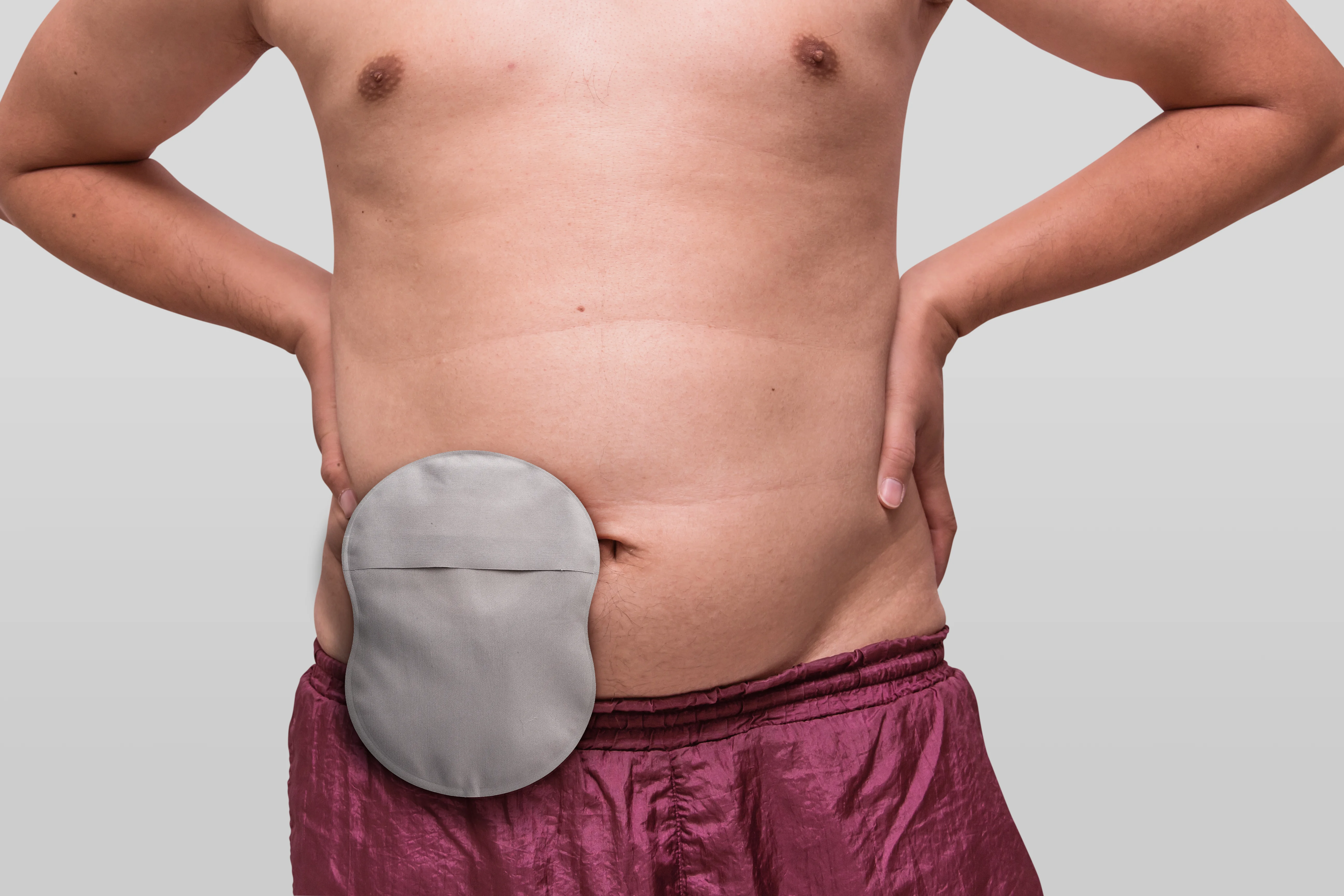 Homem com uma ostomia mostrando sua bolsa